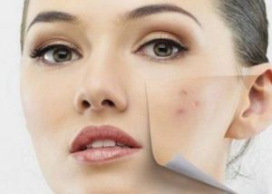 Bingung Pilih Masker Untuk Bekas Jerawat? Coba deh Bahan Alami Ini