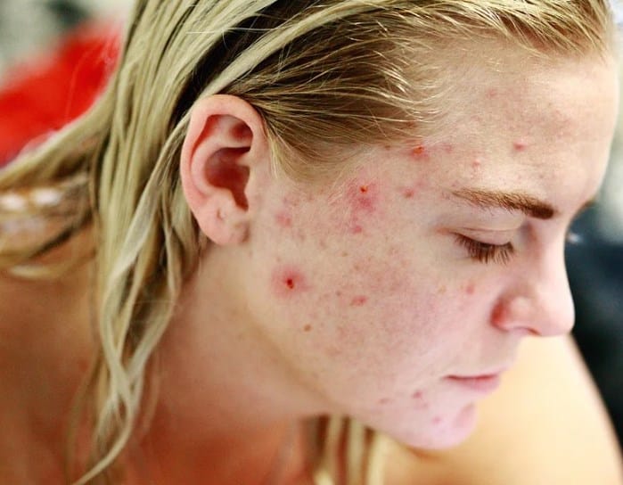 8 Bahan Skincare Ini Wajib Dihindari Jenis Kulit Sensitif