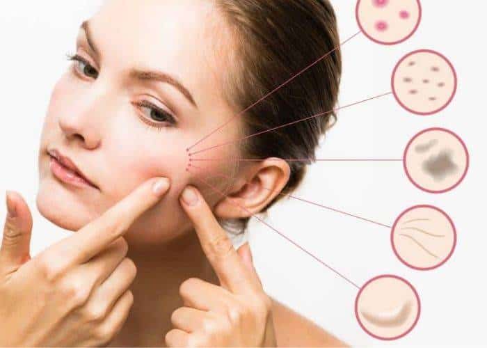 8 Tanda Kulit Kamu Nggak Cocok dengan Skincare Kamu Saat Ini